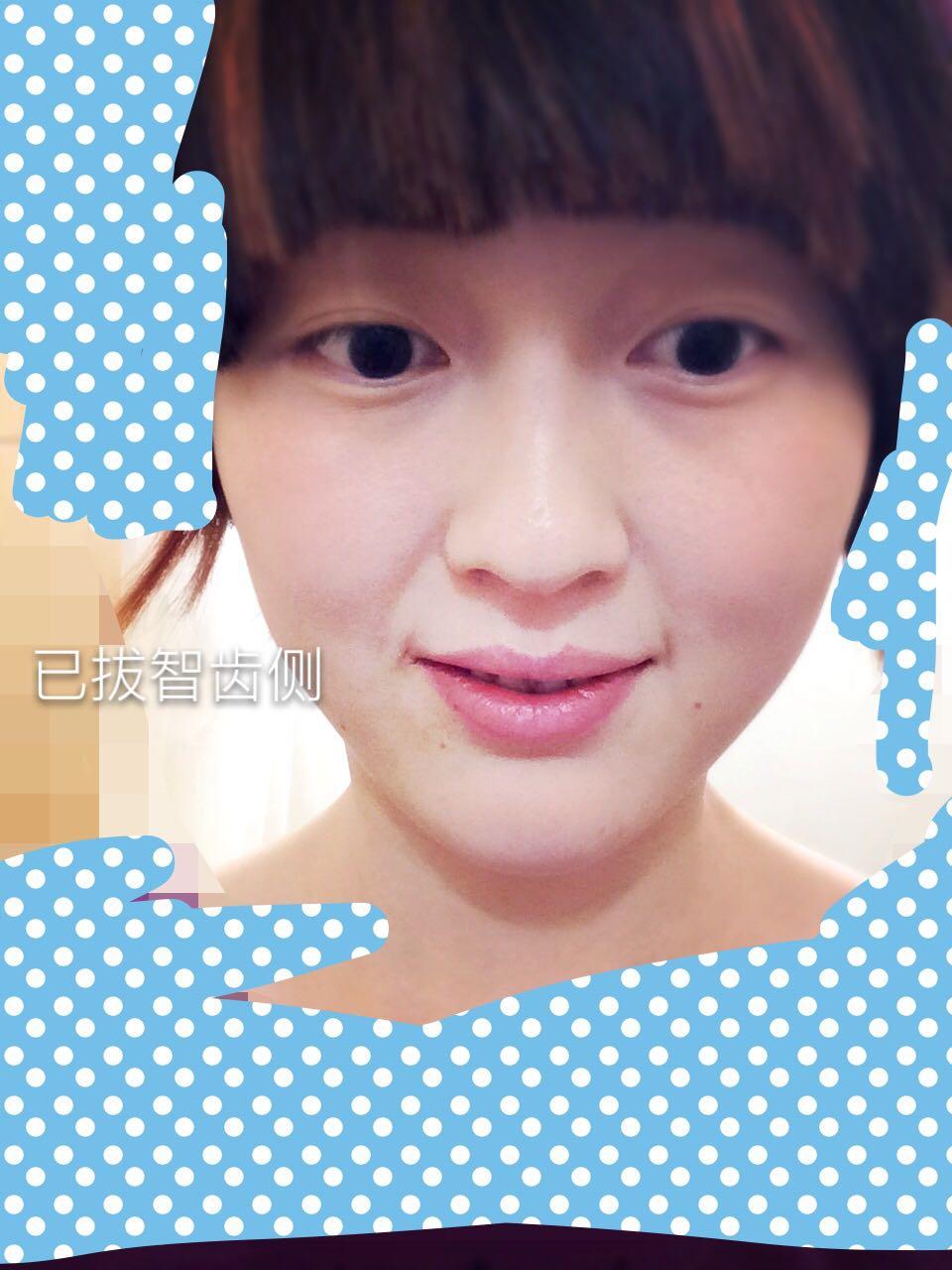 拔牙可以调整脸型么? - 杉杉的回答