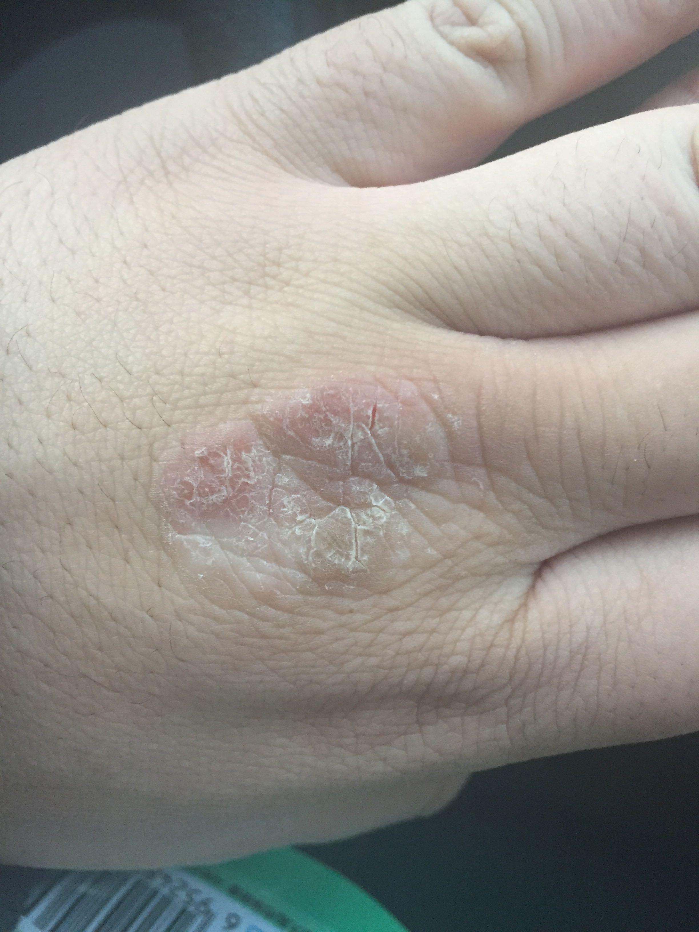 左手骨节处皮肤有一元硬币大小结痂裂口