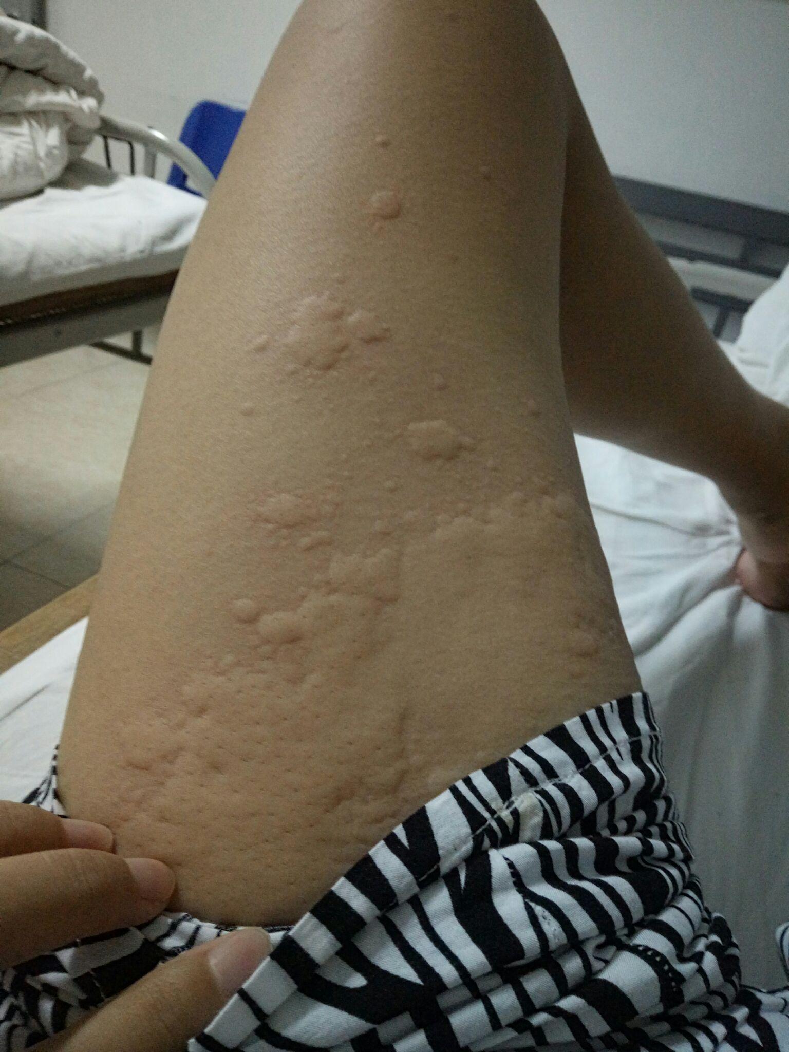 荨麻疹的真实图片图片