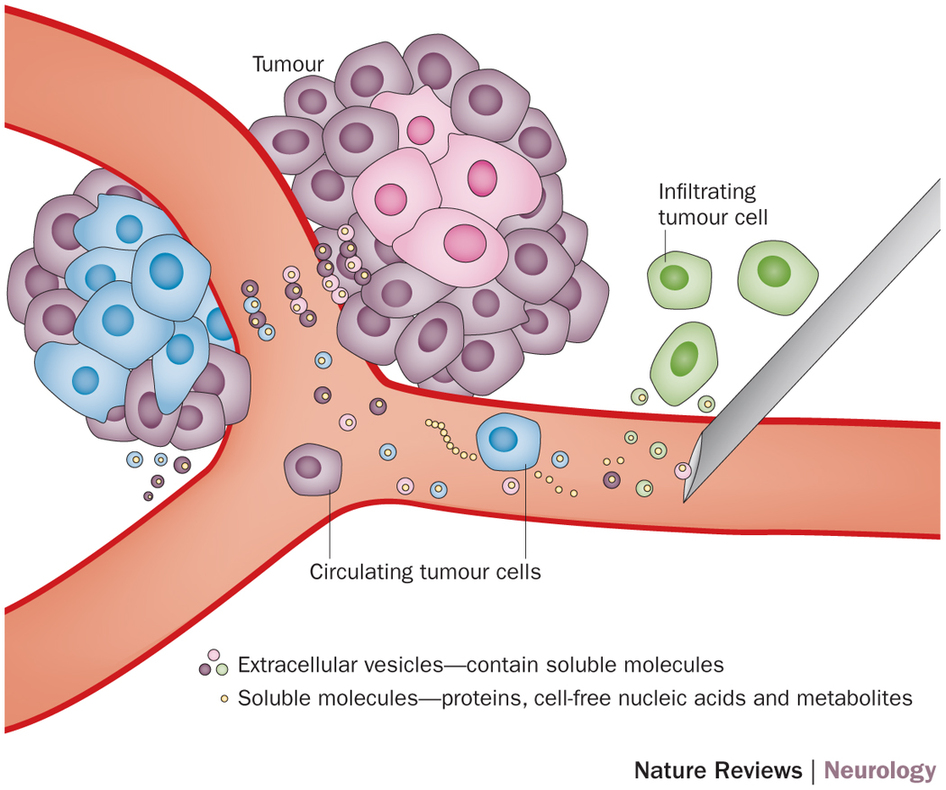 【乳腺癌】CTC和ctDNA对乳腺癌预后的判断孰