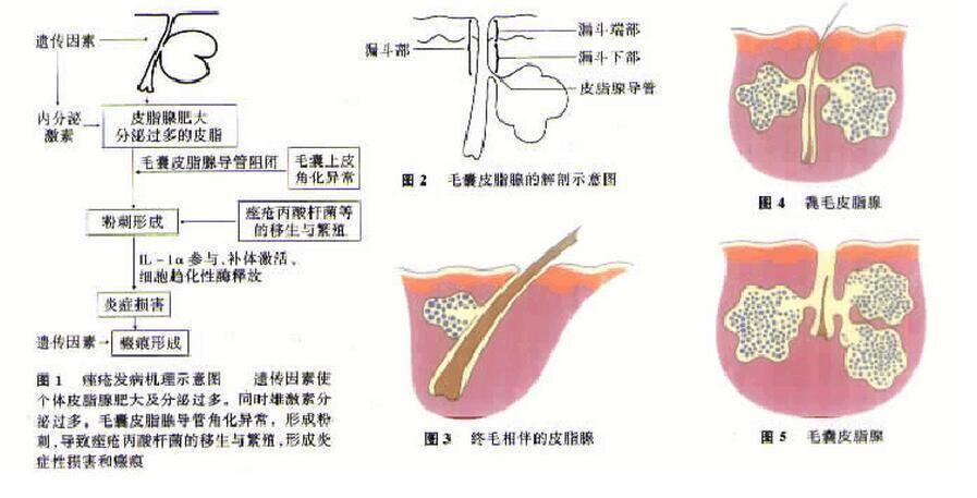 痤瘡是毛囊皮脂腺的慢性炎症.