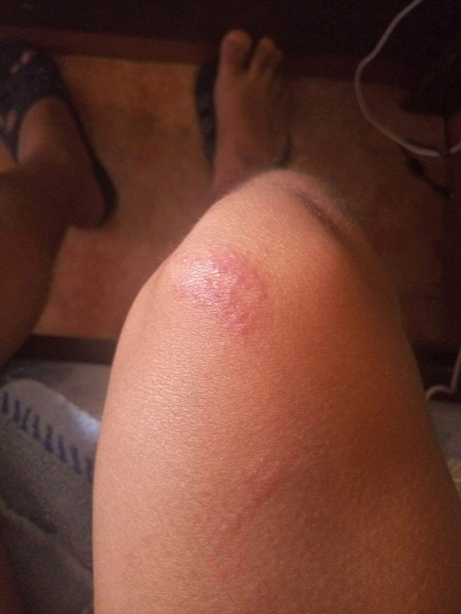 几天前潜水膝盖磕到了珊瑚为什么现在红了一片还又疼又痒怎么解波斯湾