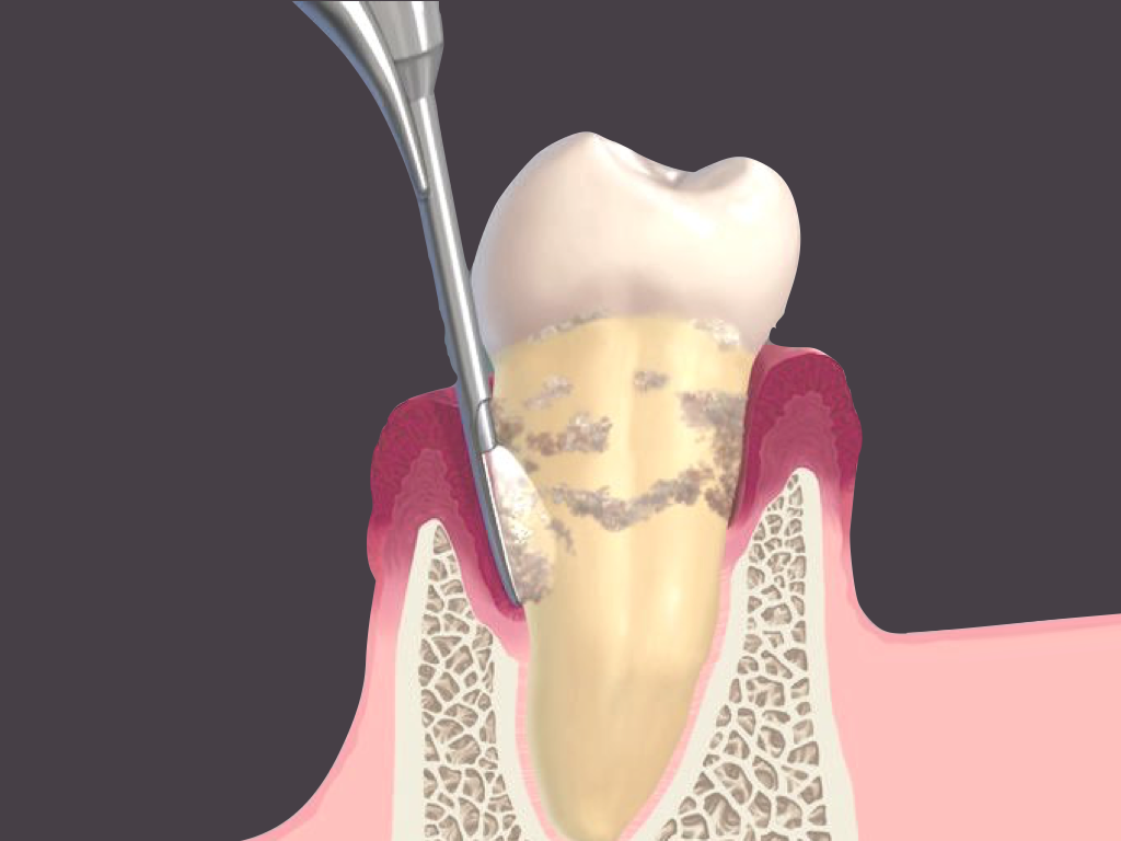 牙结石——牙菌斑基质与唾液钙爱情的结晶_治疗