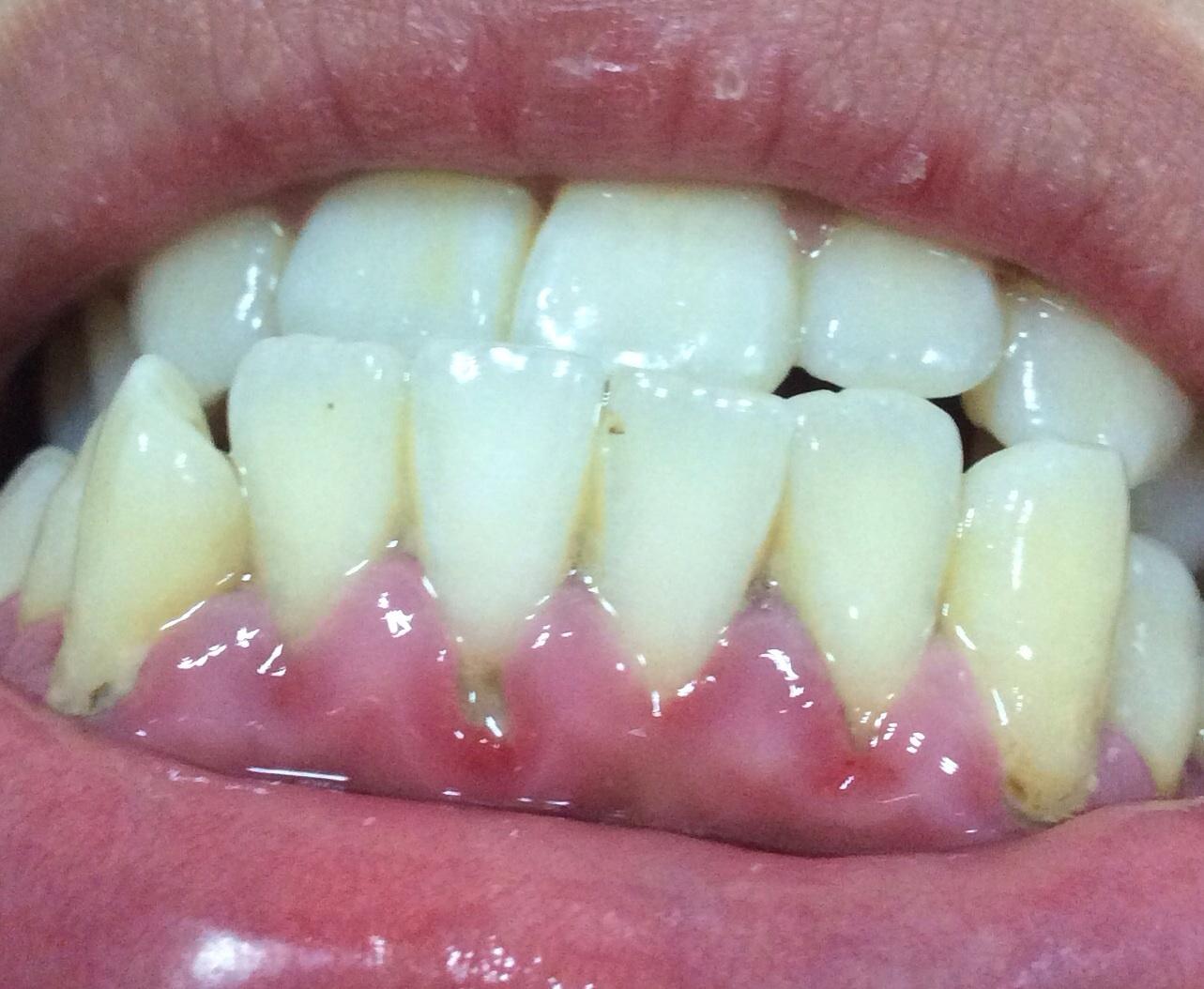 牙龈容易出血图片