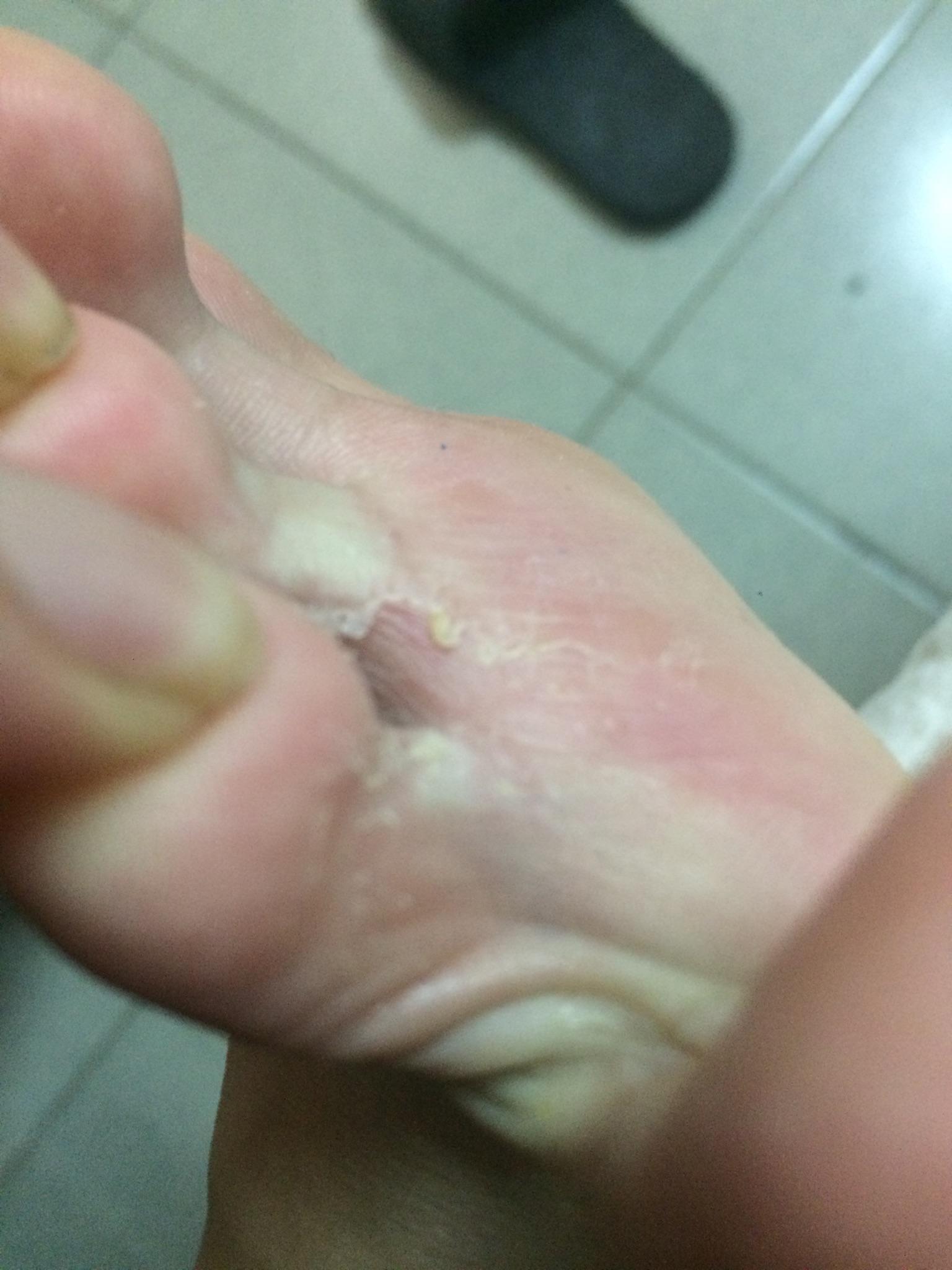 请问这是糜烂型脚气吗