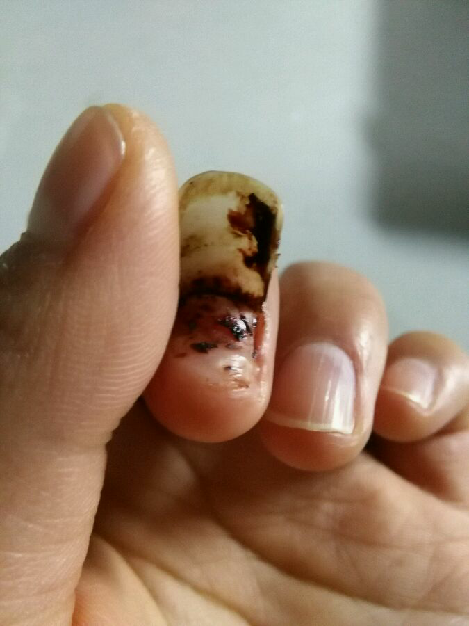 指甲被连根拔起是什么体验