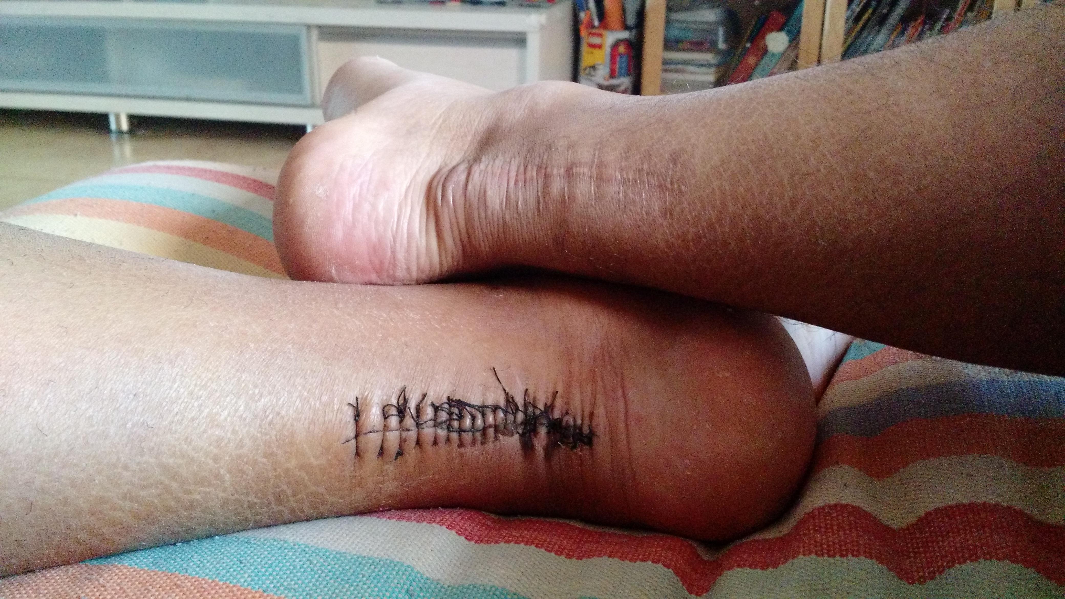 跟腱断裂有多疼