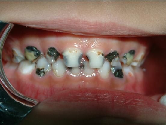 牙釉质发育不完全是怎么变成这样的换牙会好吗四岁半孩子