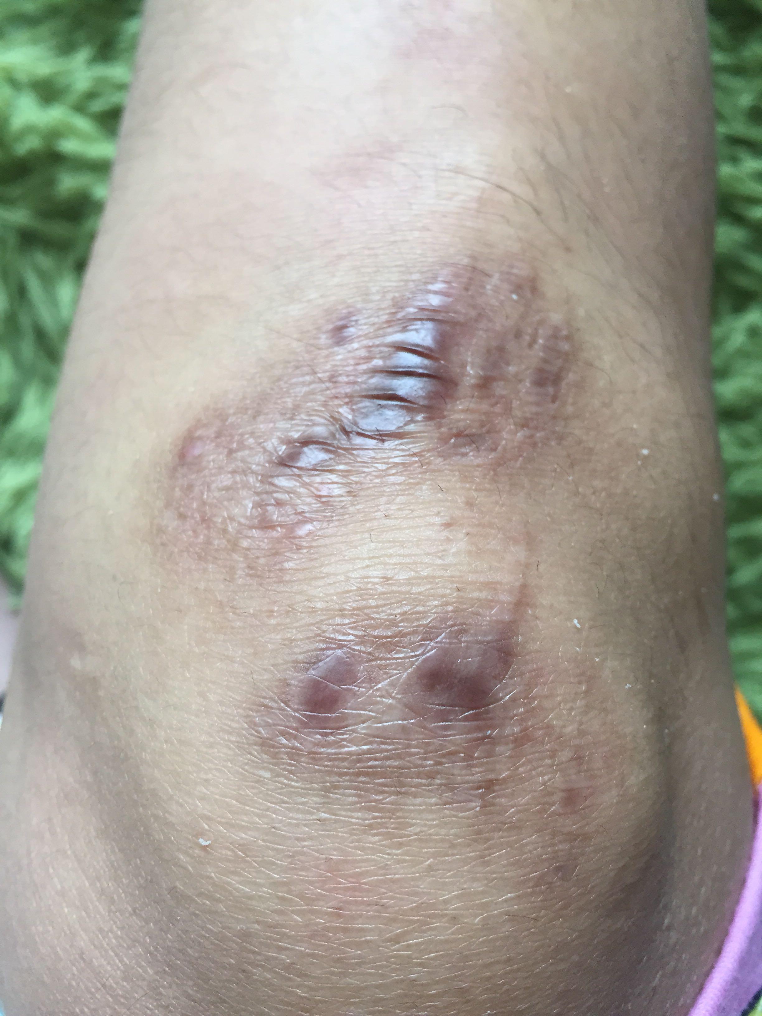 5个月凸起增生疤会痒偶尔刺痛求去除方案