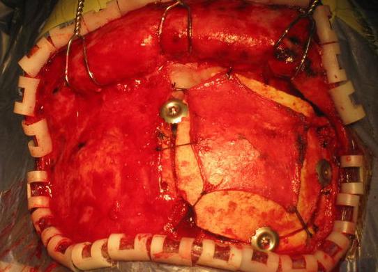 开颅手术的全部流程是怎样的