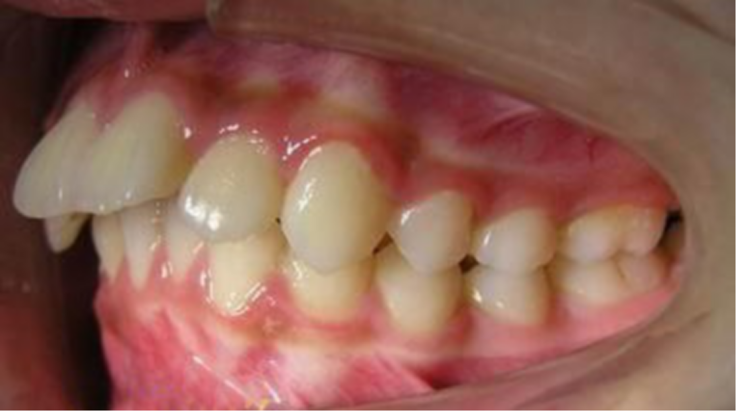 有缺失的不齐牙齿也可以变整齐 - 贝致案例库 - 贝致——专业口腔服务平台，权威医生，真实案例，一次看够