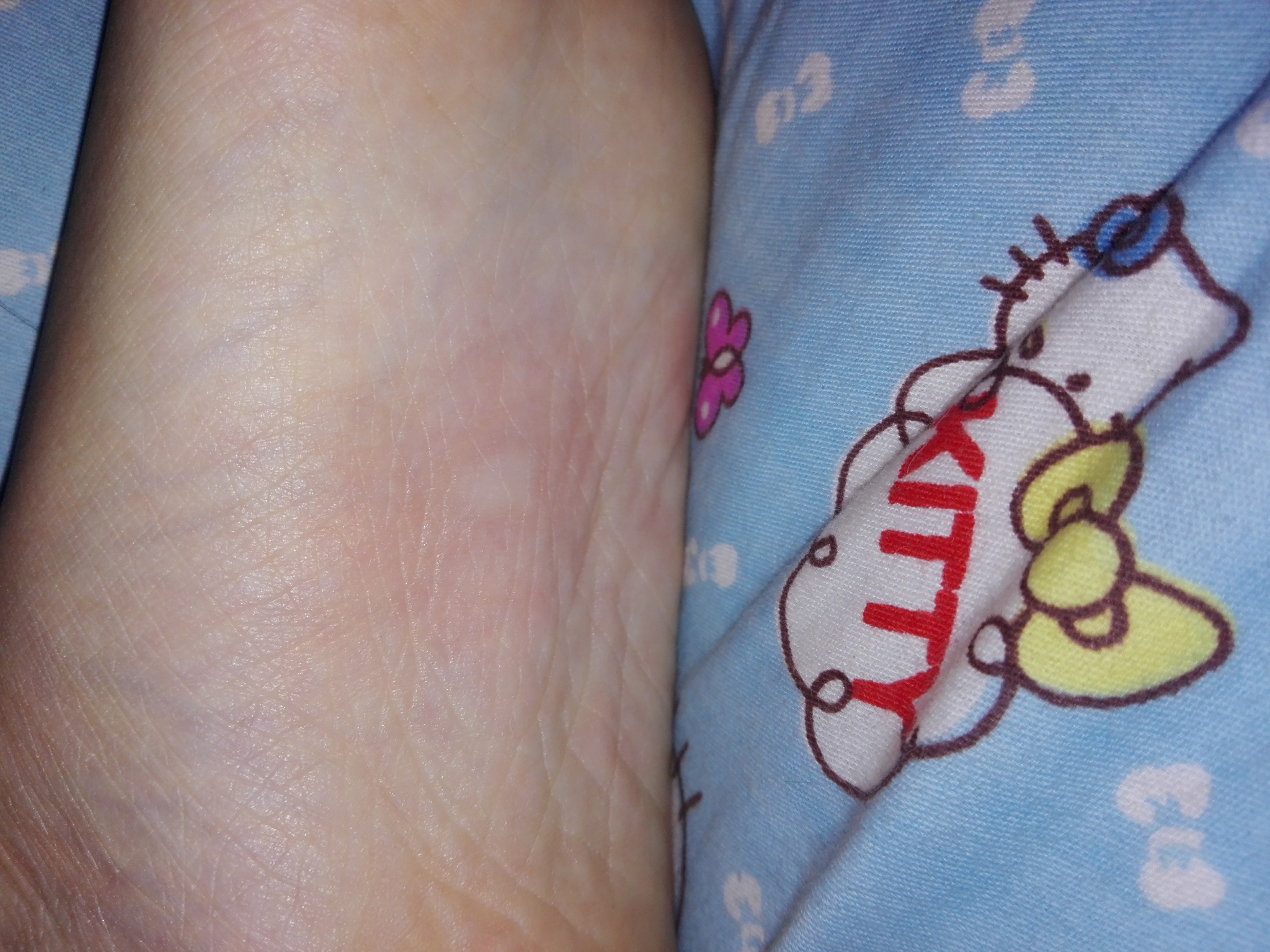 脚心被蚊子咬了是一种什么体验? - 知乎