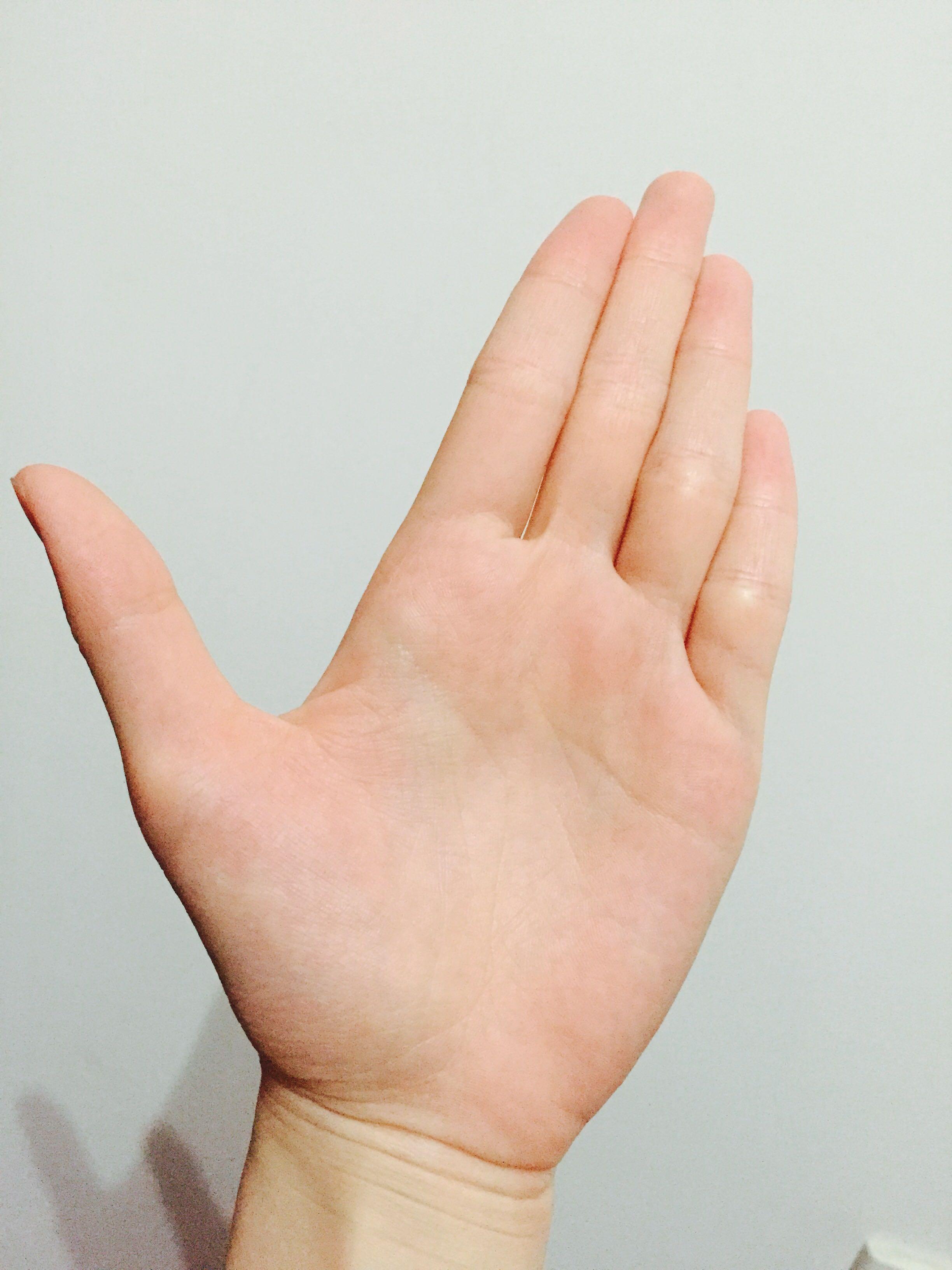 女生,左右手小指均有三条纹理线,看上去呈四节状,实质为正常手指