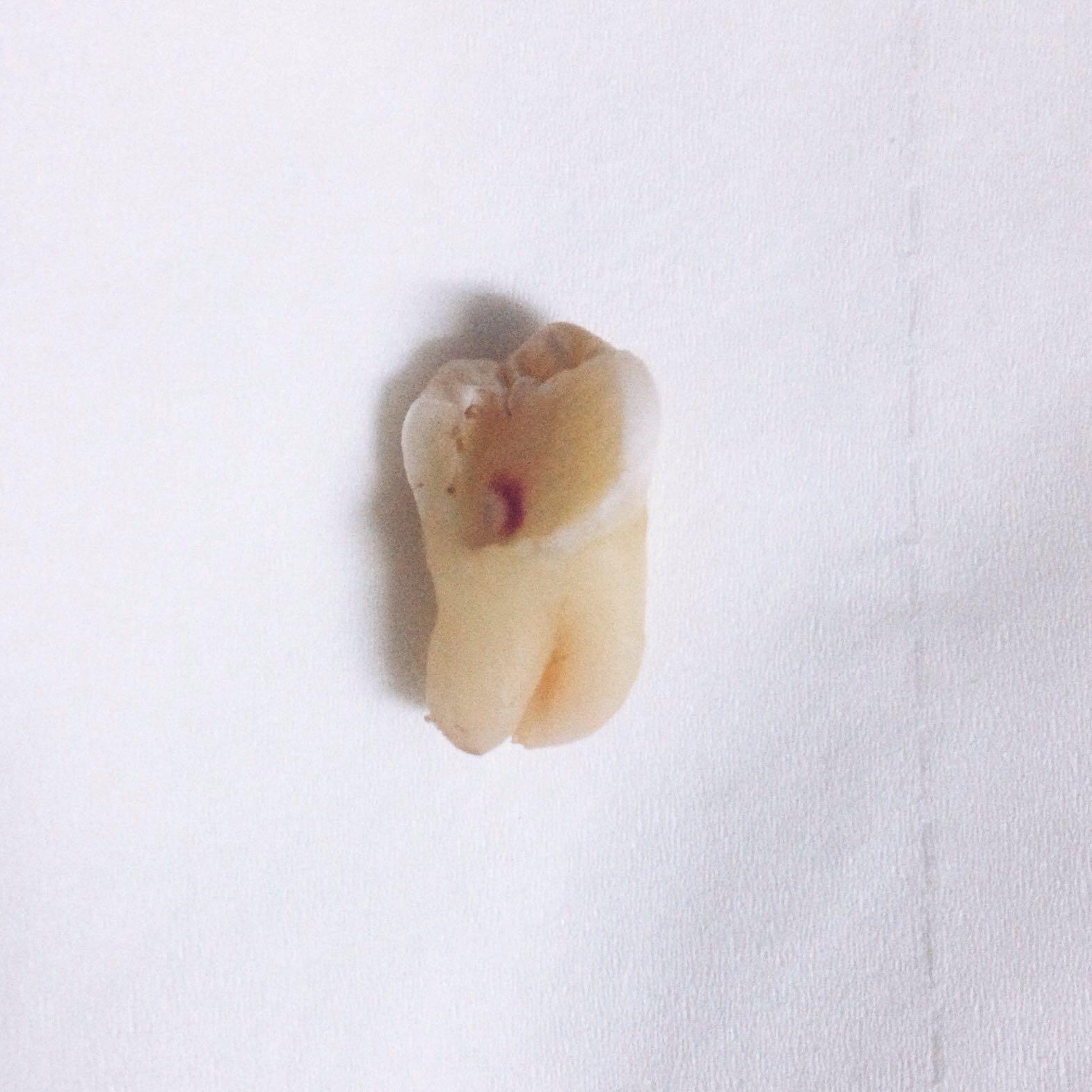 拔智齿有多痛? - 李团子的回答 - 知乎