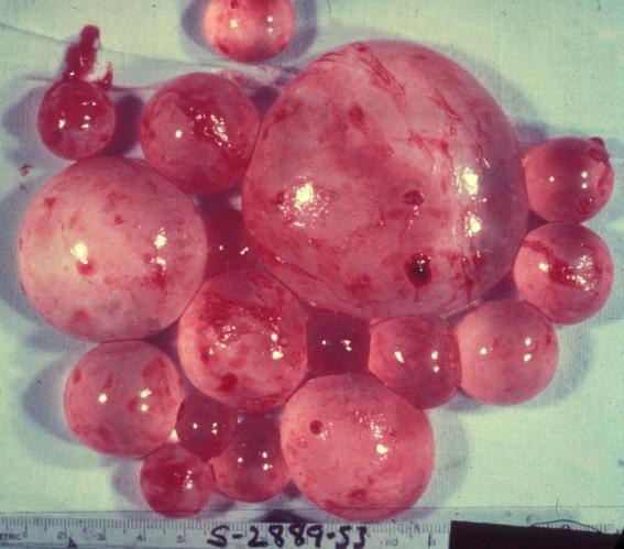 细粒棘球蚴病图片图片
