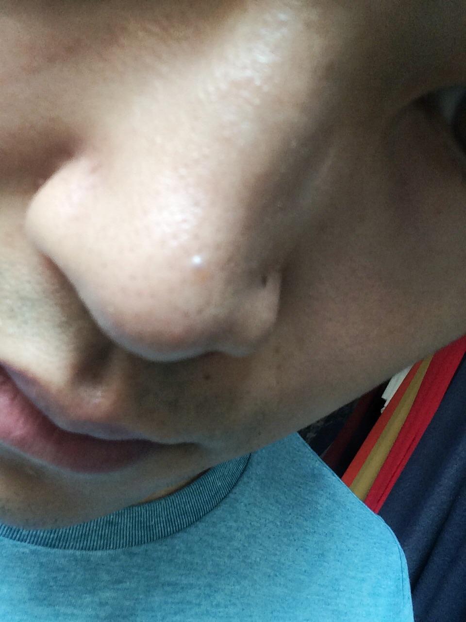 鼻子上这个灰色透明痘痘是什么?