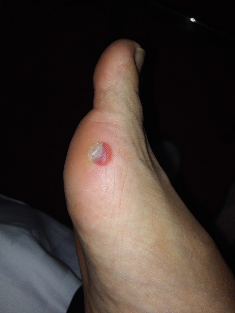 跑步脚趾起血泡怎么办阿感觉脚要烂了