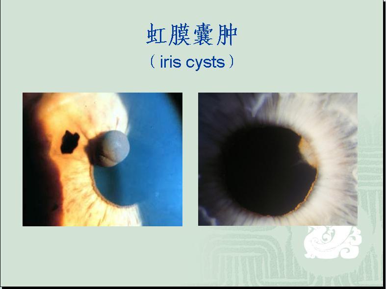 历史上的重瞳子是真实存在的吗?两个瞳仁在眼睛里是如何分布的? - 知乎