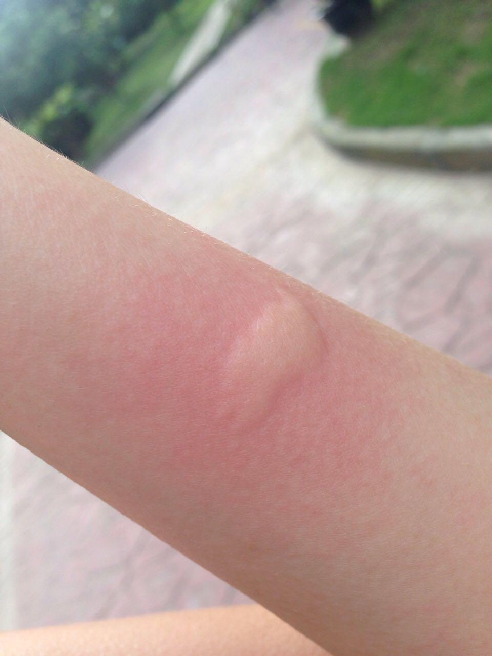 貌似被白纹伊蚊咬了会出事吗