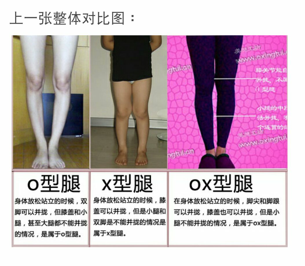 ox型腿图示,ox型腿和xo型腿的区别 - 伤感说说吧