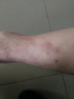 腿上有疤,怎么祛疤?很容易留疤,但是不容易祛