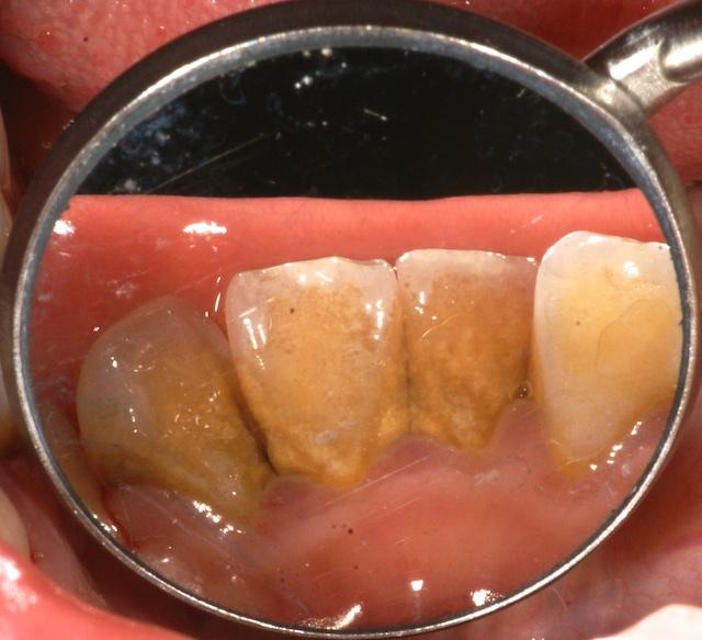 门牙内侧有尖刺一样的东西,磨得舌头疼,请问我应该怎么做?