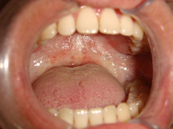 长期嚼槟榔会在一定程度上改变容貌吗