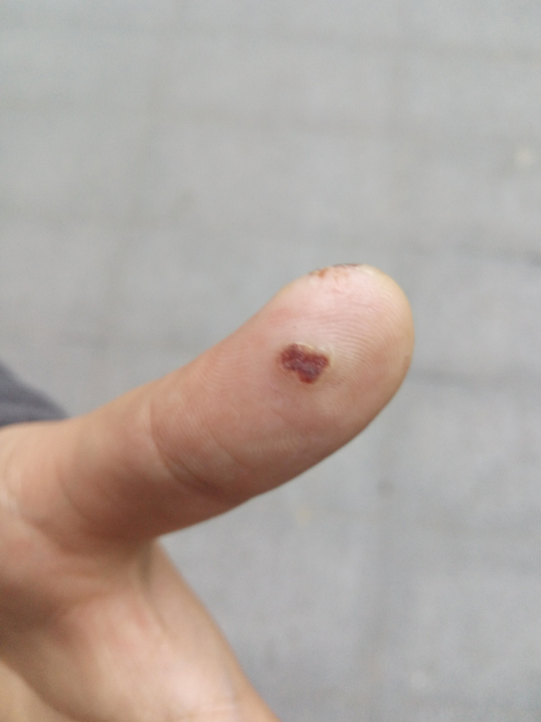 治疗手指上的寻常疣鱼鳞痣有什么办法或者药物