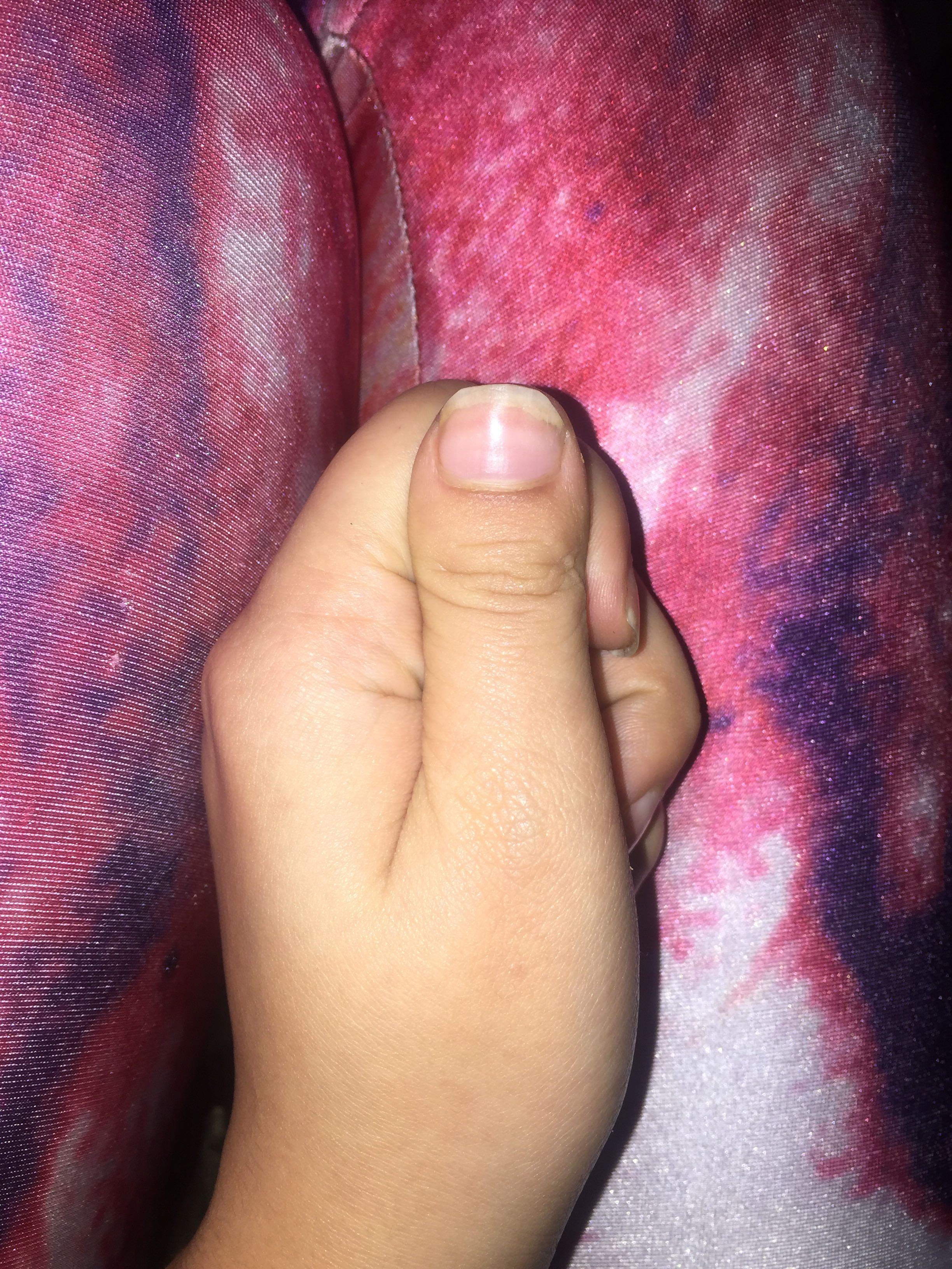 手指头指甲短小扁是怎么回事?