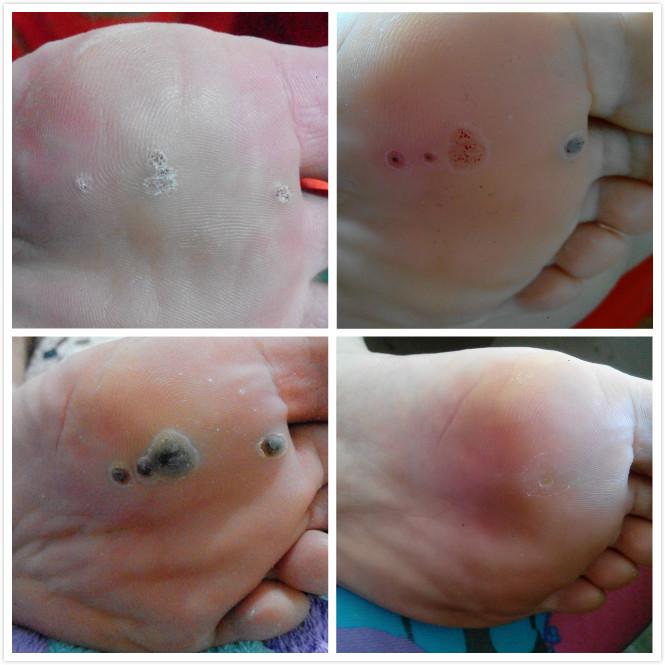 脚底长跖疣怎么办