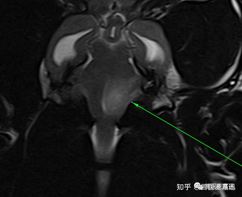 1分钟读懂前庭综合征(Vestibular disease) - 知乎