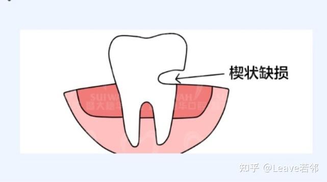 楔状缺损画图图片