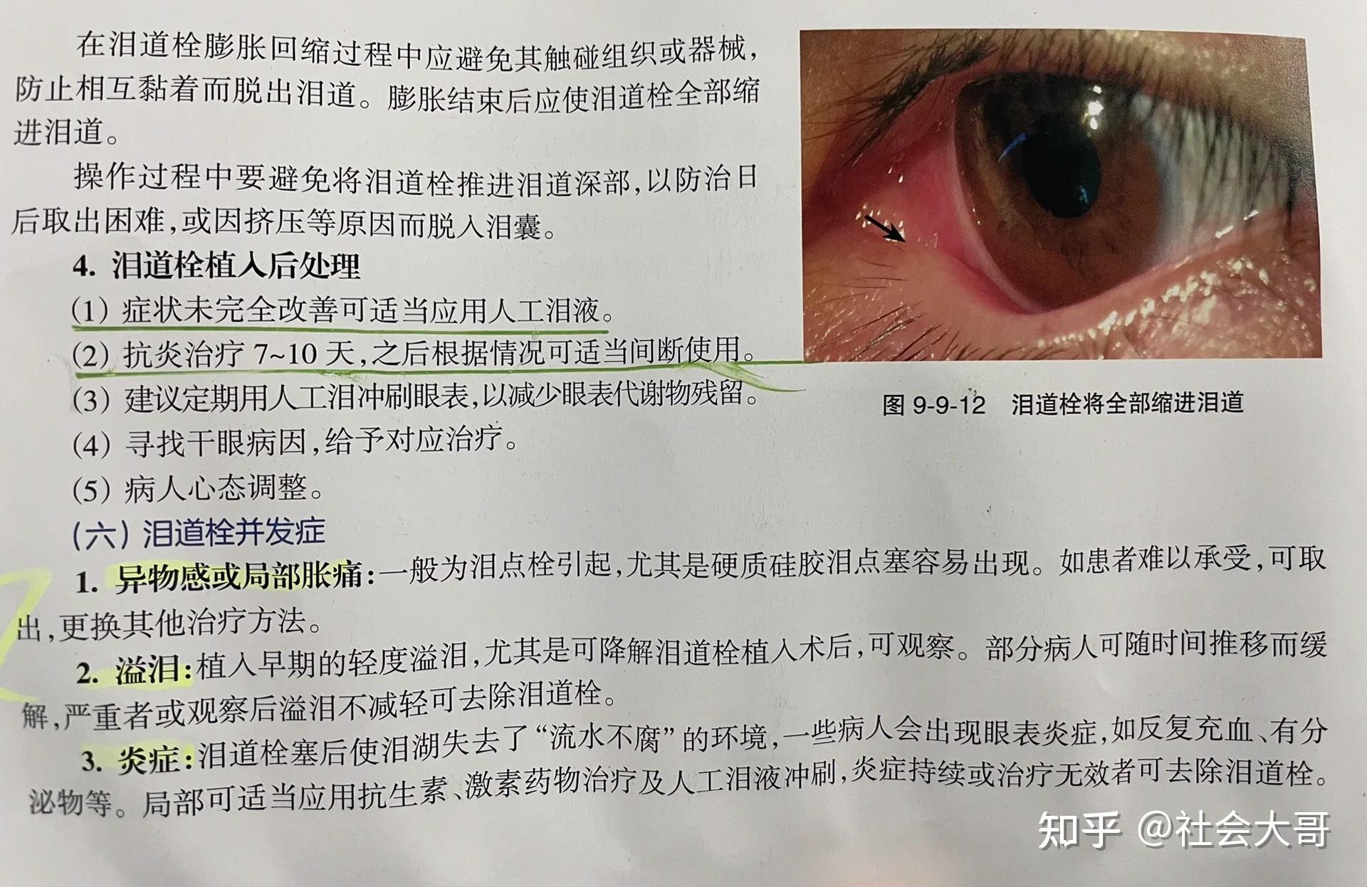 干眼症｜泪小点手术你不知道的③件事 - 知乎