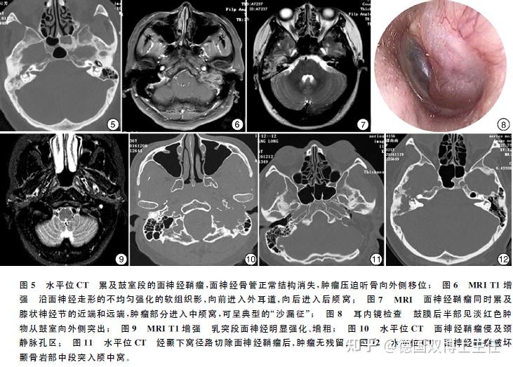 面神经鼓室段图片