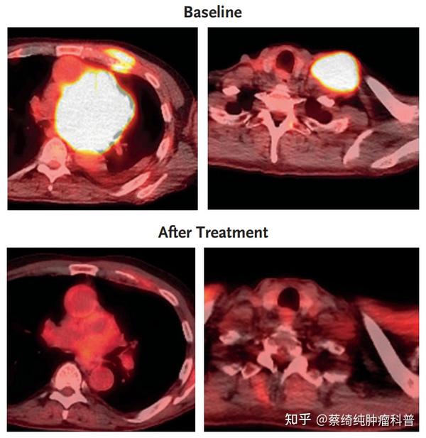 CAR-T细胞疗法进展（8） - 知乎