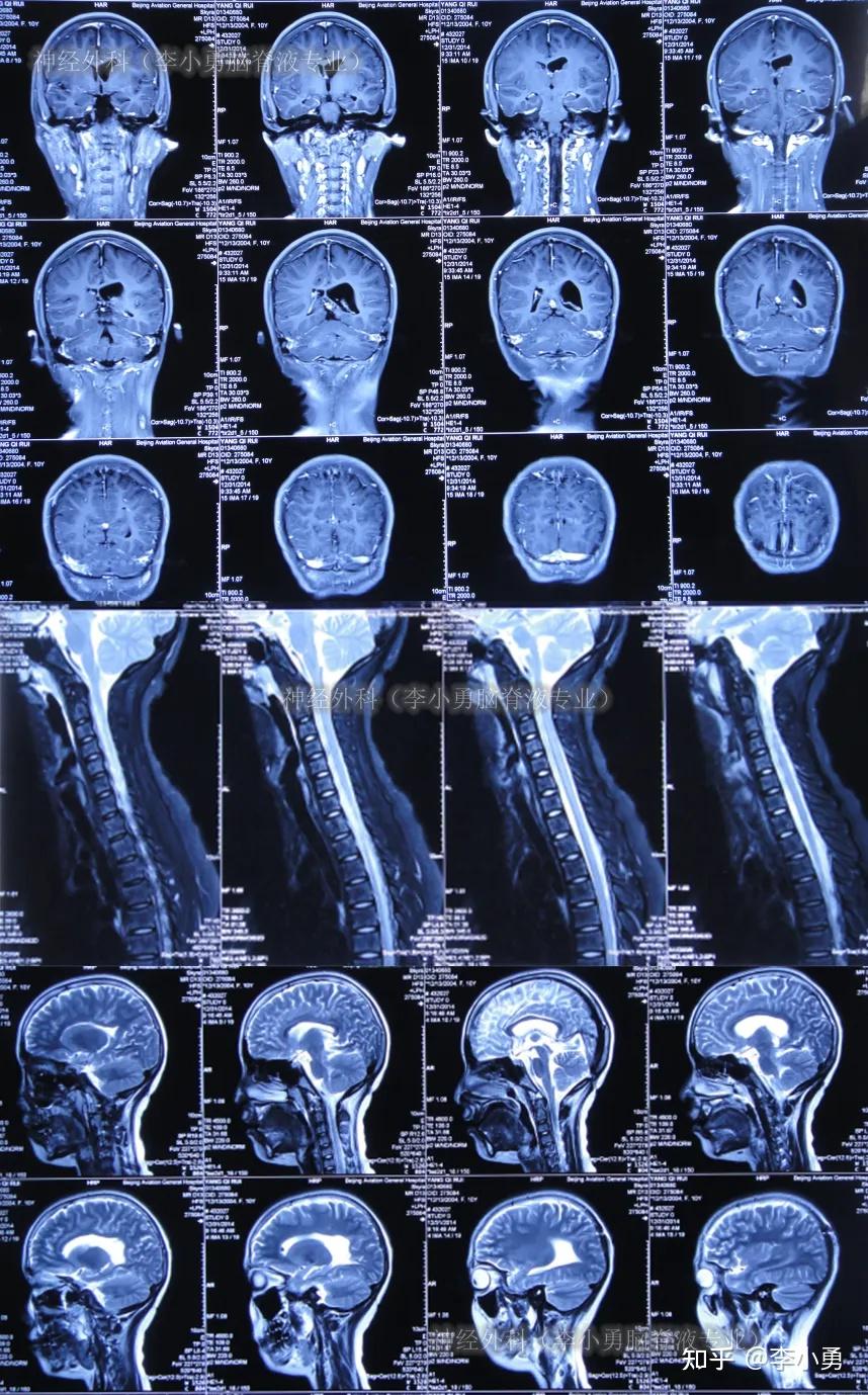 脑部核磁片子图片