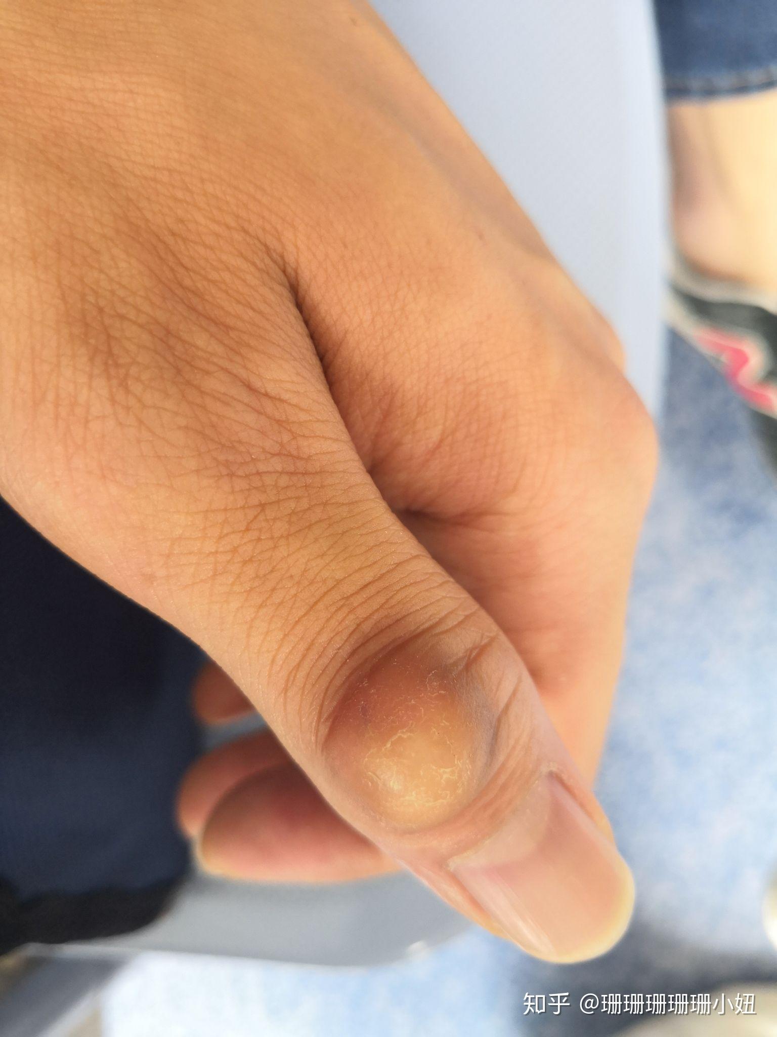 指节垫怎么治疗,长在左手,已经有三年了,表面就是硬皮,抠掉一层又长