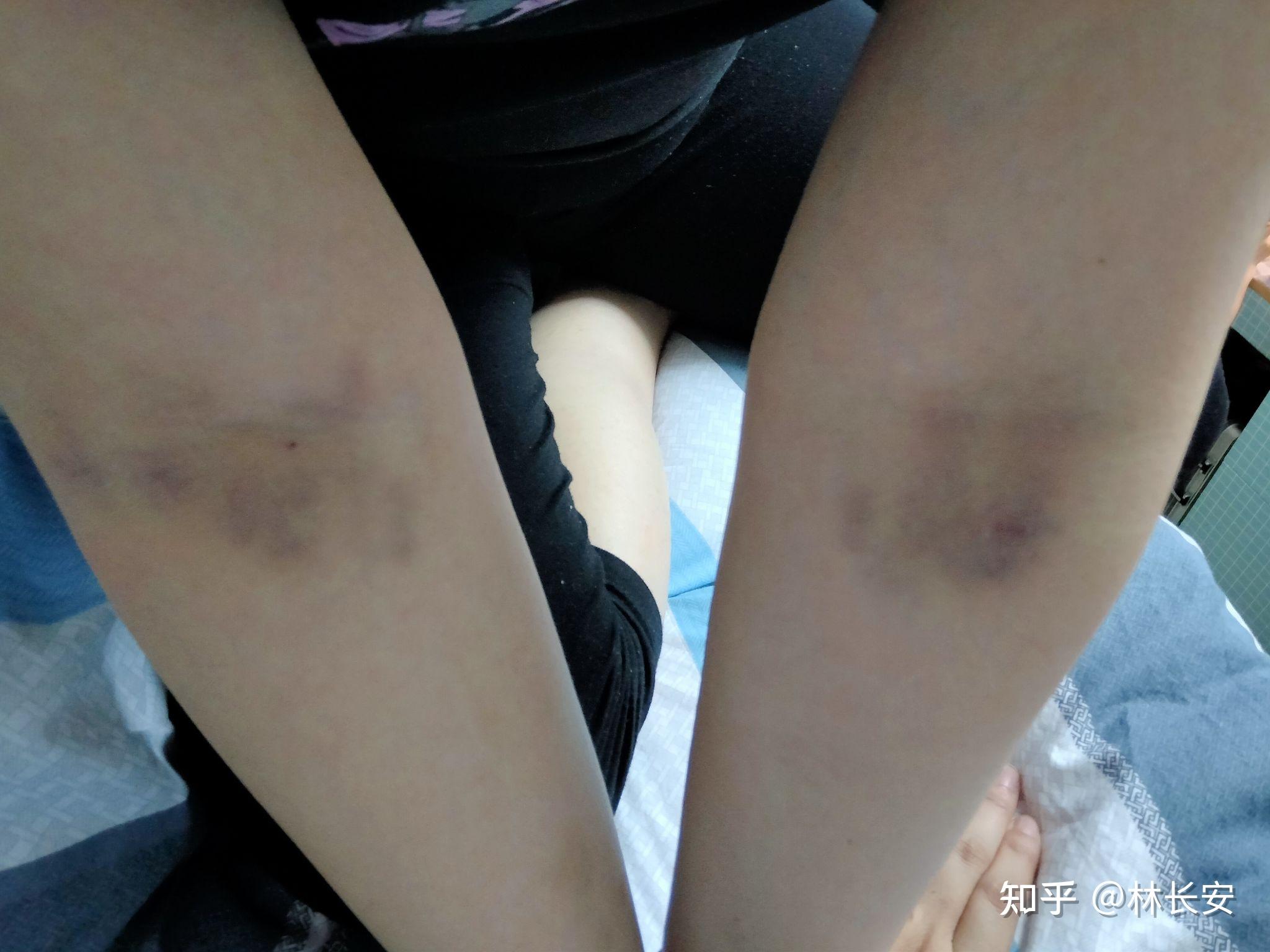 抽血后抽血处淤青得很严重? - 知乎