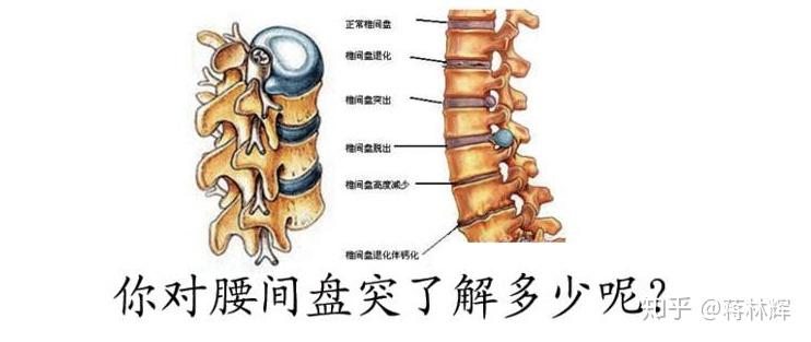 腰间盘突出的要做什么 运动.腰间盘突出要怎么运动