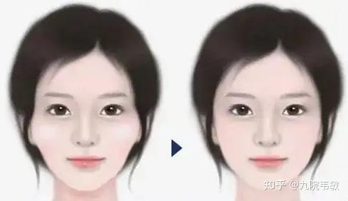 九院韦敏说,颧弓颧骨内推or磨骨,如何选择? - 知乎