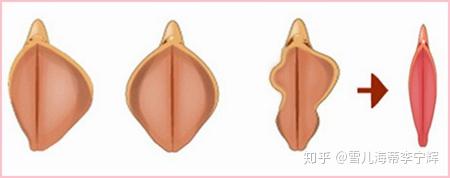 嘘!这是关于女性的小私密——小阴唇整形术