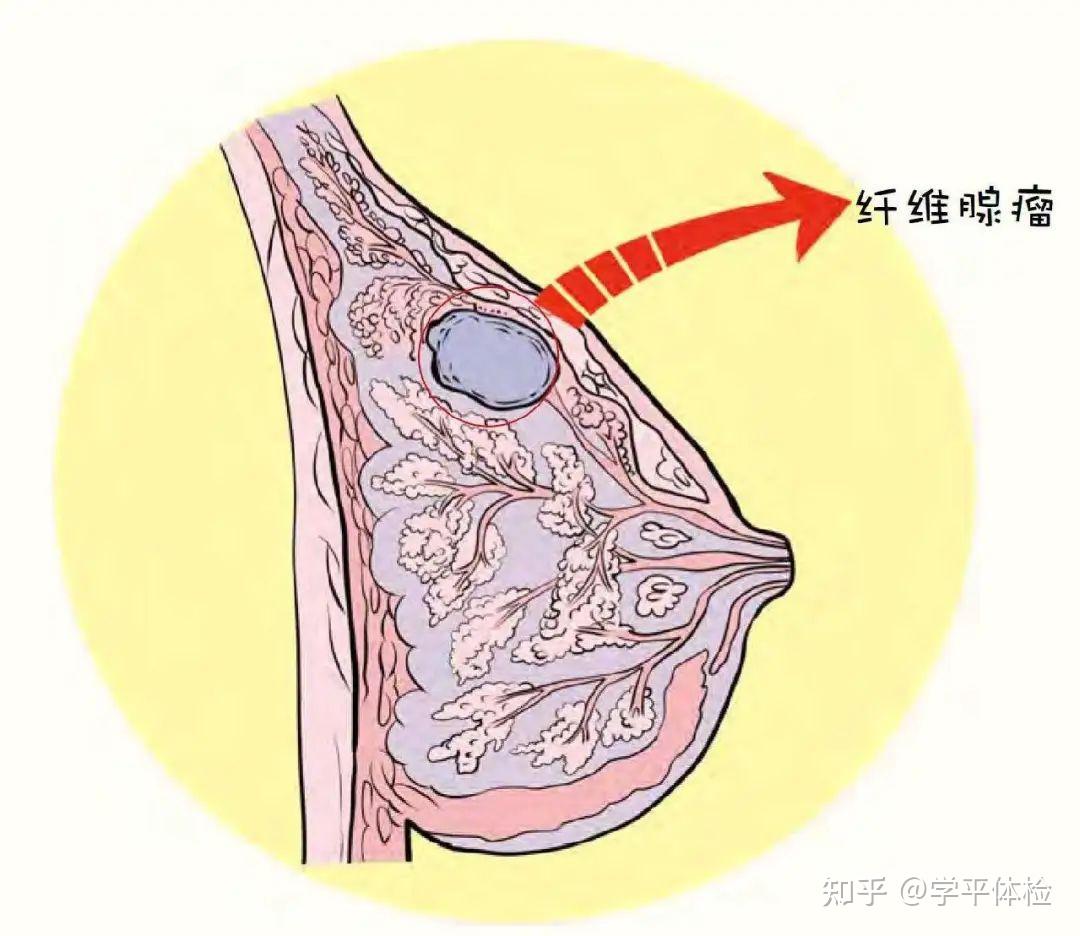 乳腺纤维腺瘤是一种育龄期女性最常见的乳腺肿瘤,绝大多数都是良性