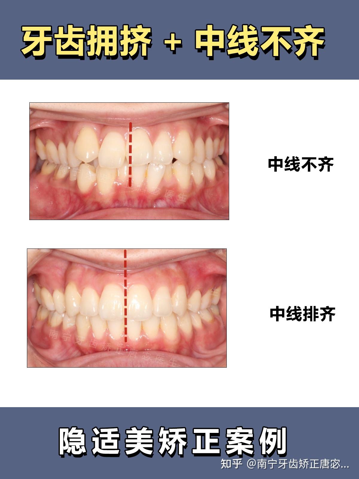 南宁牙齿矫正