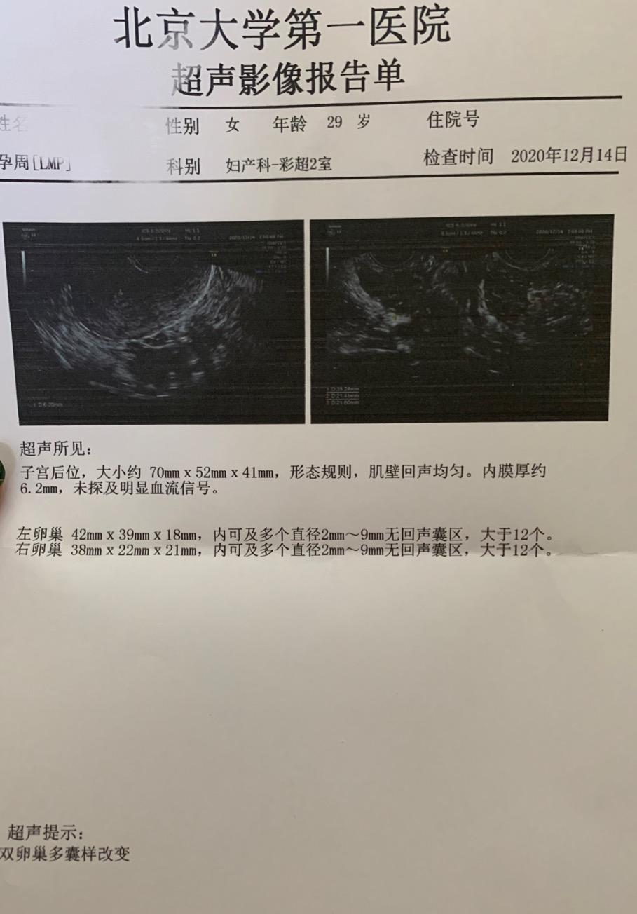 多囊卵巢綜合症調整一月全記錄