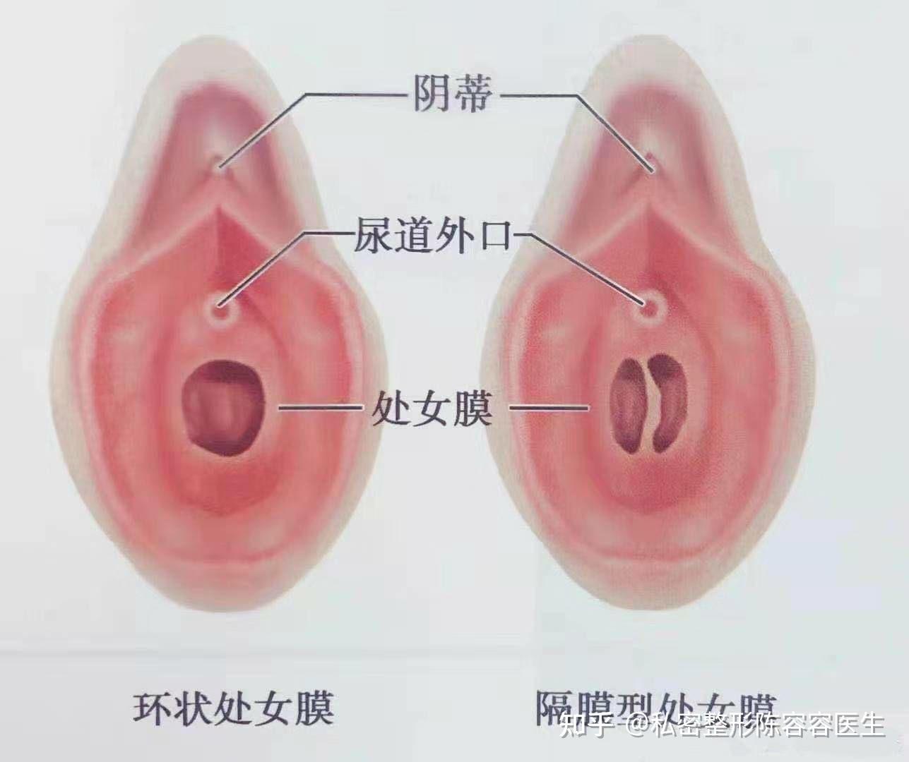 处女膜 
