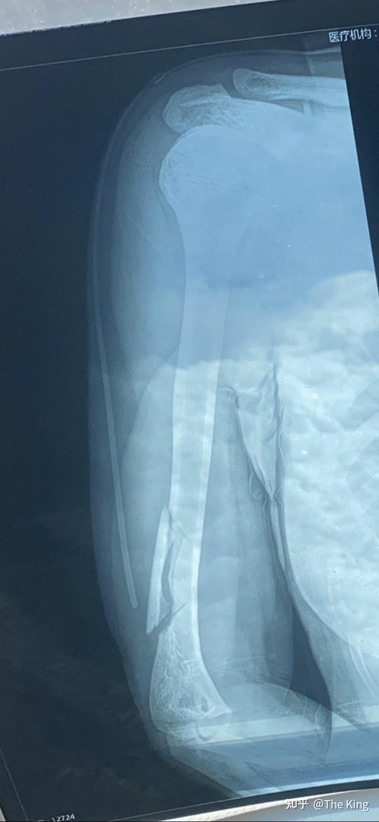 室,当时感觉手臂跟身体不连在一起了,从医务室坐车去镇上卫生院拍ct