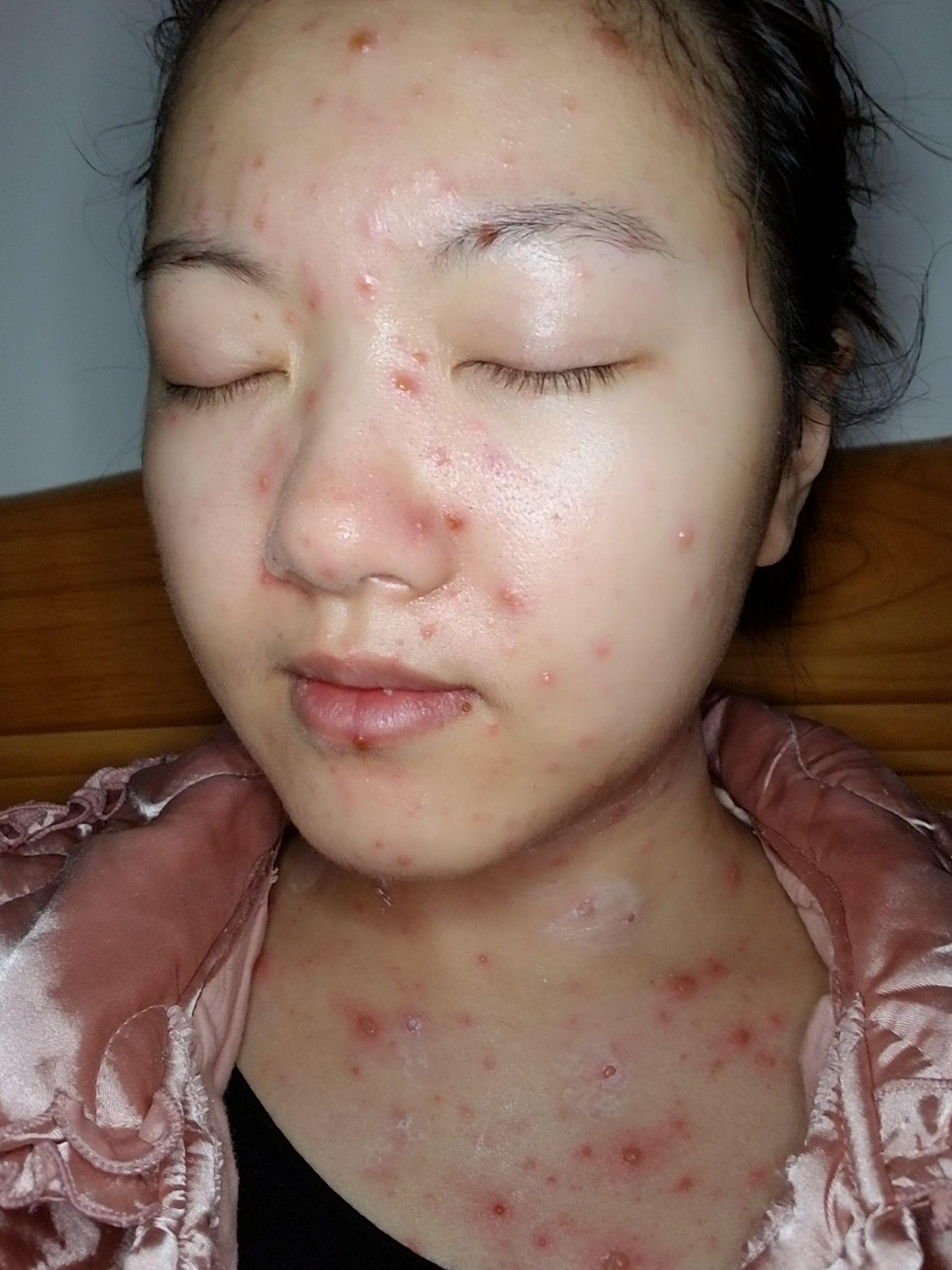 长水痘是一种怎么样的体验? - 知乎