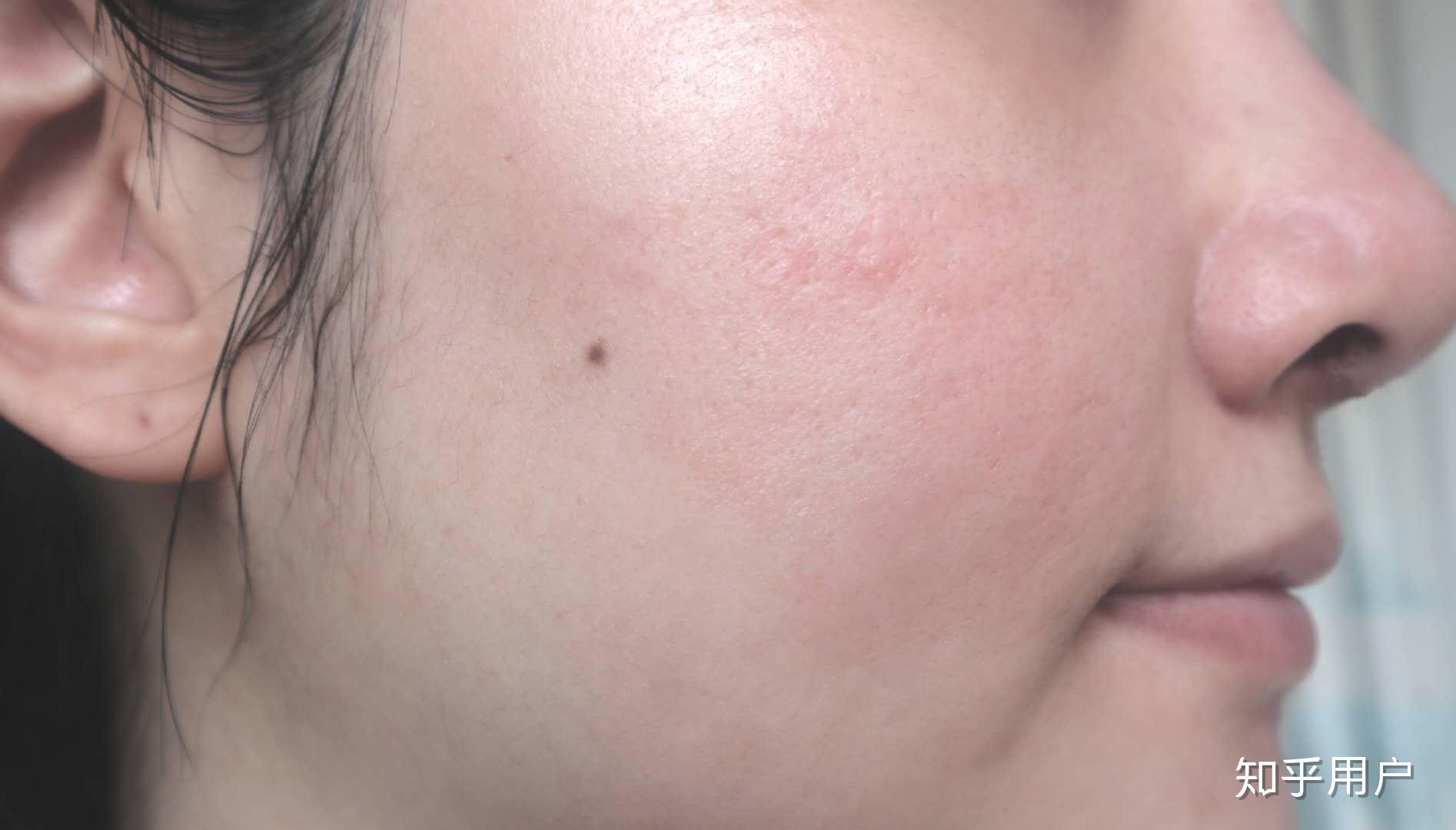 这种痘印怎么消除