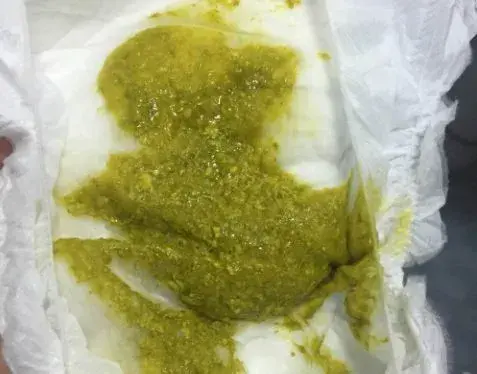 女宝8个月大,牛奶高度敏感,医生让吃深度水解奶粉,但她一直强烈拒绝