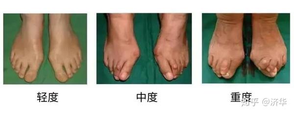 注意 30 女性的脚都有这种病 医生建议 千万别这样做 知乎